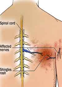 Rapid Recovery Therapy for Shingles